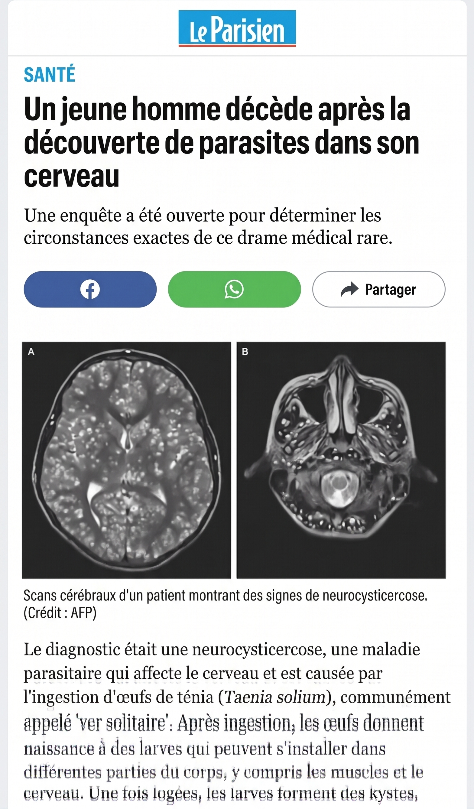 Scan cérébral
